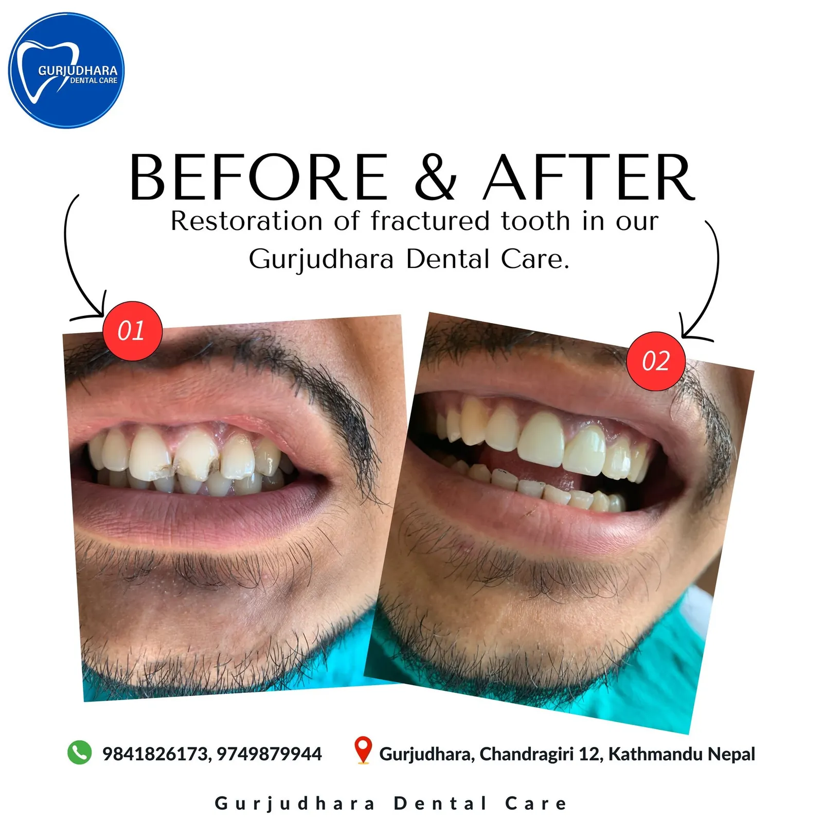 Before and after a fractured front tooth rebuilt at Gurjudhara Dental Care, Chandragiri