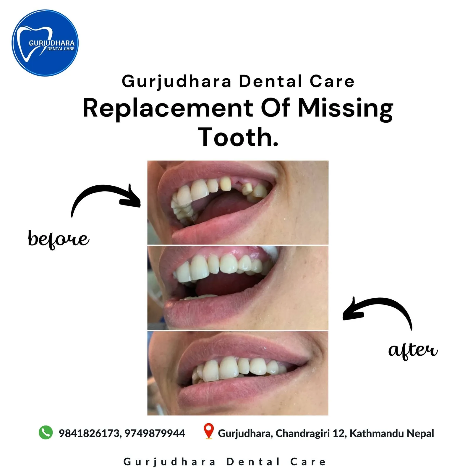 Before and after a missing front tooth replaced at Gurjudhara Dental Care, Chandragiri