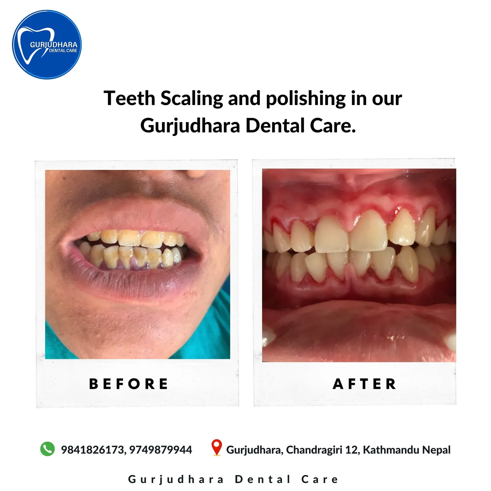 Before and after teeth scaling and polishing at Gurjudhara Dental Care, Chandragiri-12