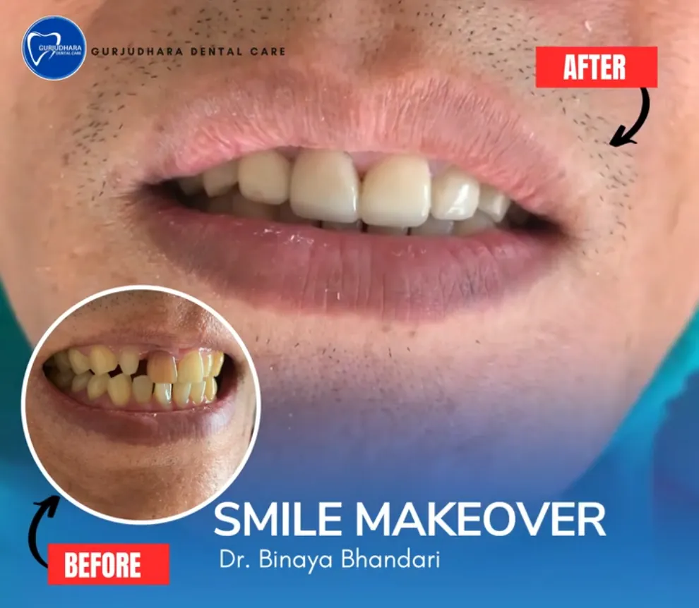 Before and after a smile makeover by Dr. Binaya Bhandari at Gurjudhara Dental Care