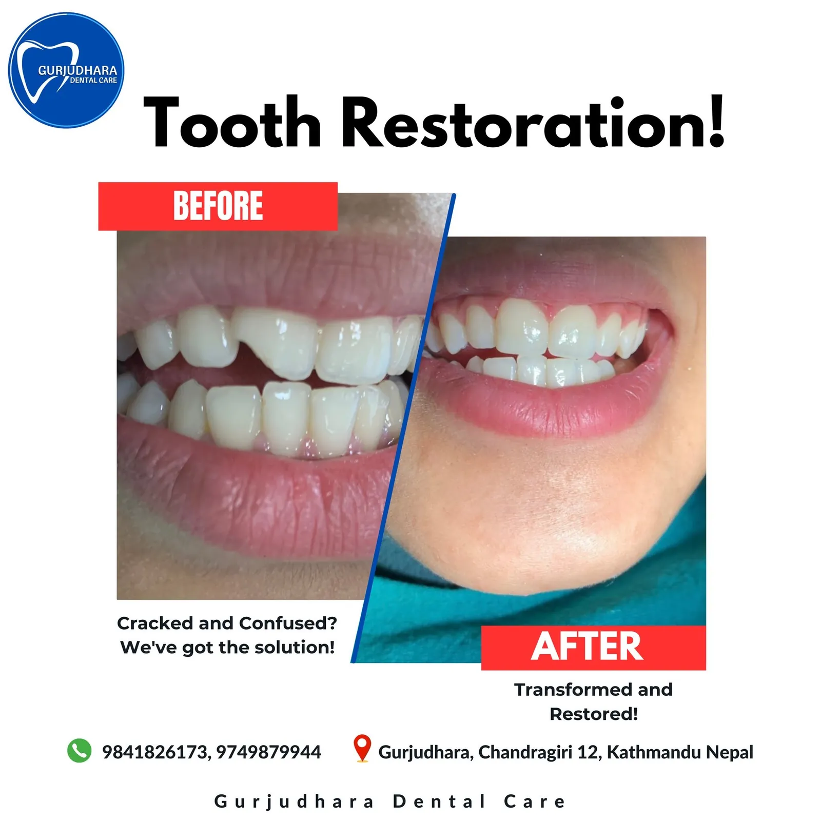 Before and after a cracked tooth restored at Gurjudhara Dental Care, Chandragiri-12