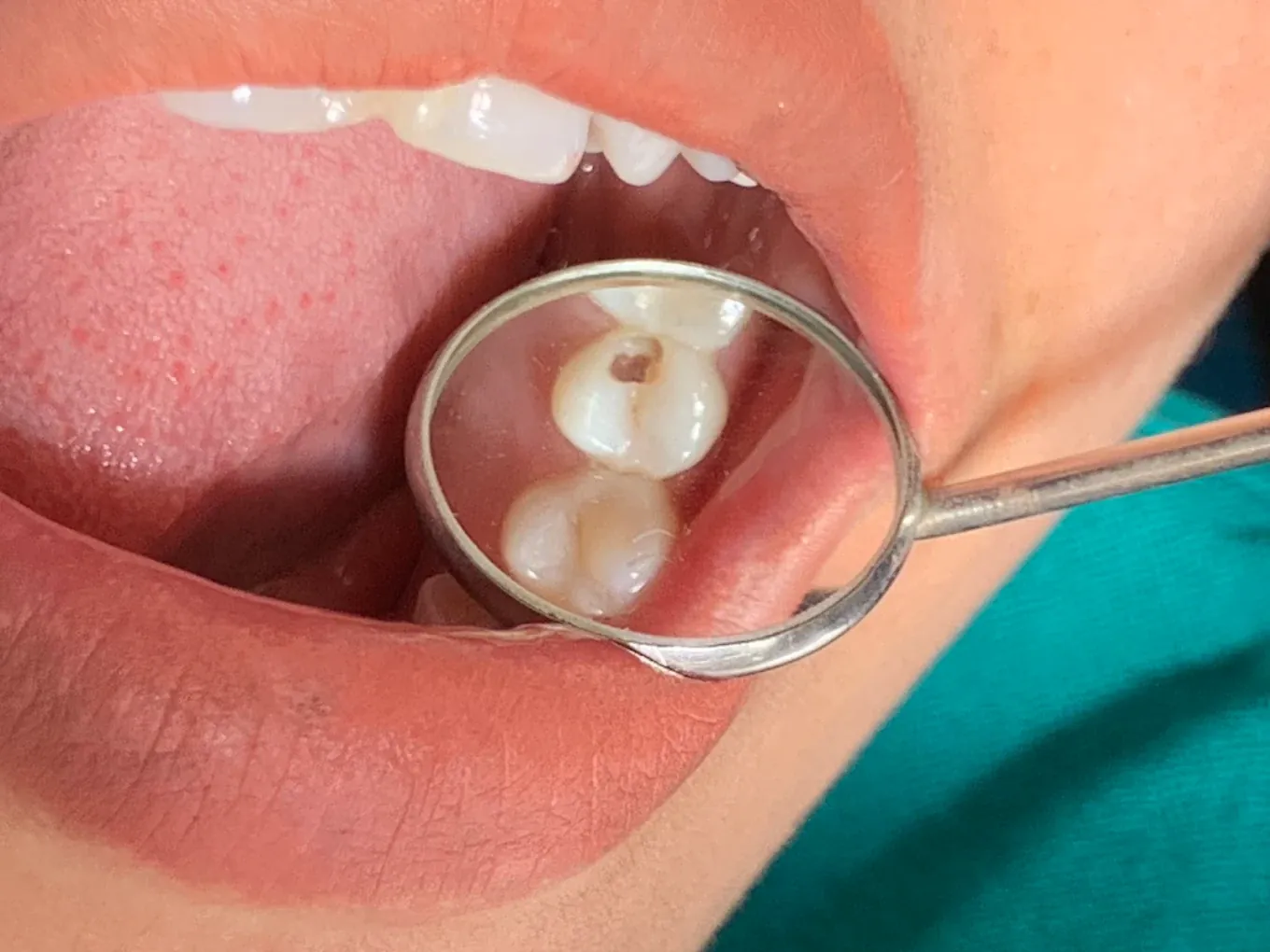 Finished composite filling checked with a mouth mirror at Gurjudhara Dental Care, Chandragiri