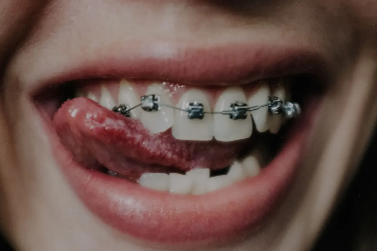 Fixed metal braces on the upper and lower teeth of a smiling orthodontic patient