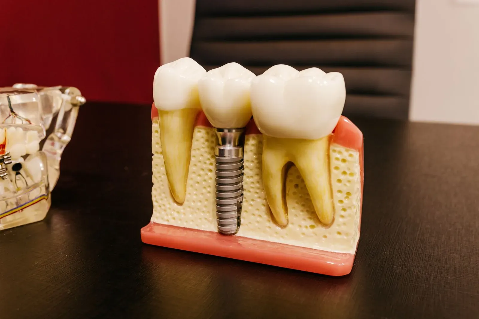 Dental implant model showing the titanium screw set in the jawbone beside a natural tooth and crown