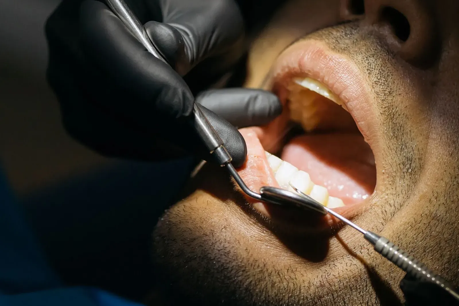 Dentist examining the soft tissue inside a patient's mouth during an oral cancer screening
