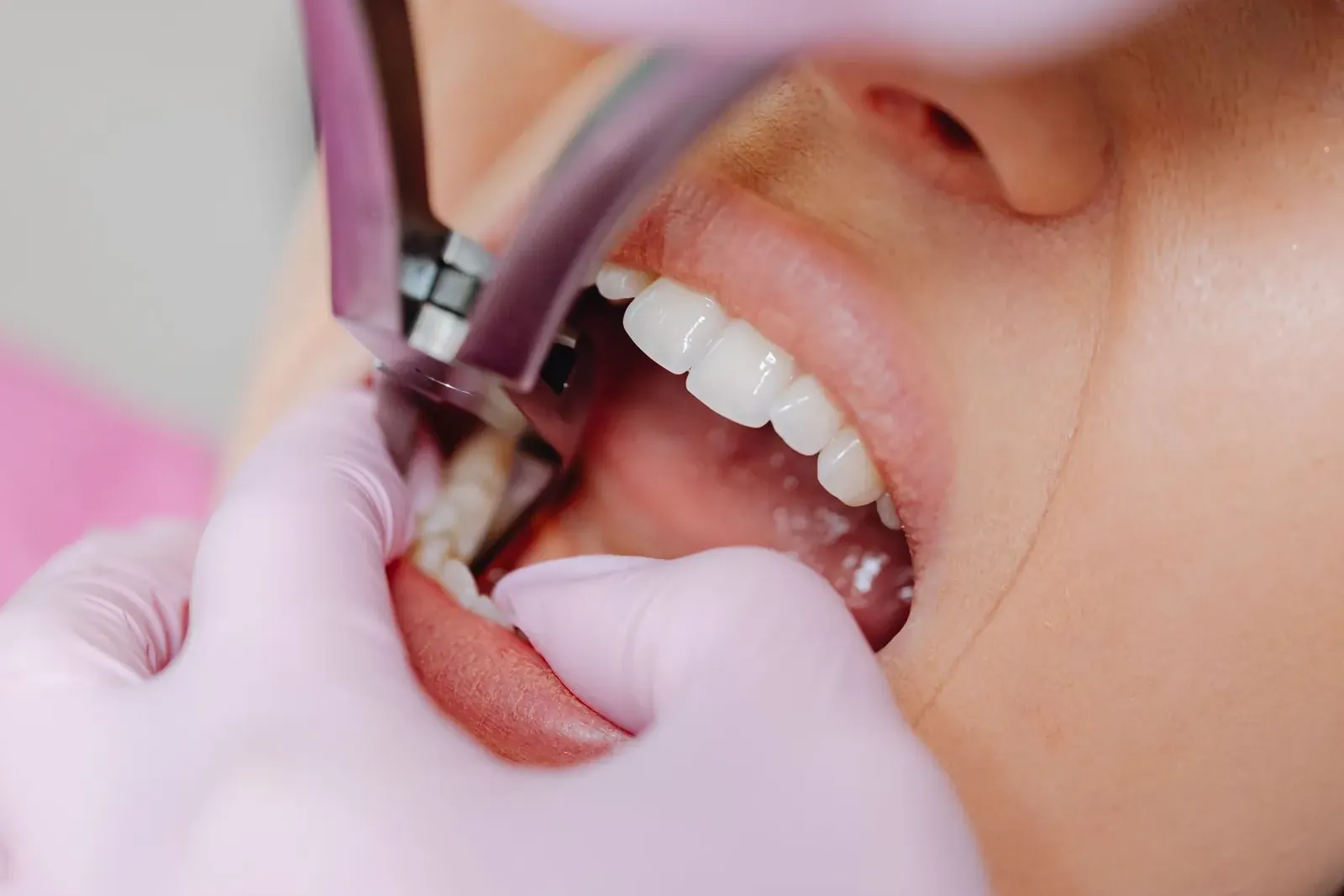 Dentist removing a tooth with extraction forceps under local anaesthetic